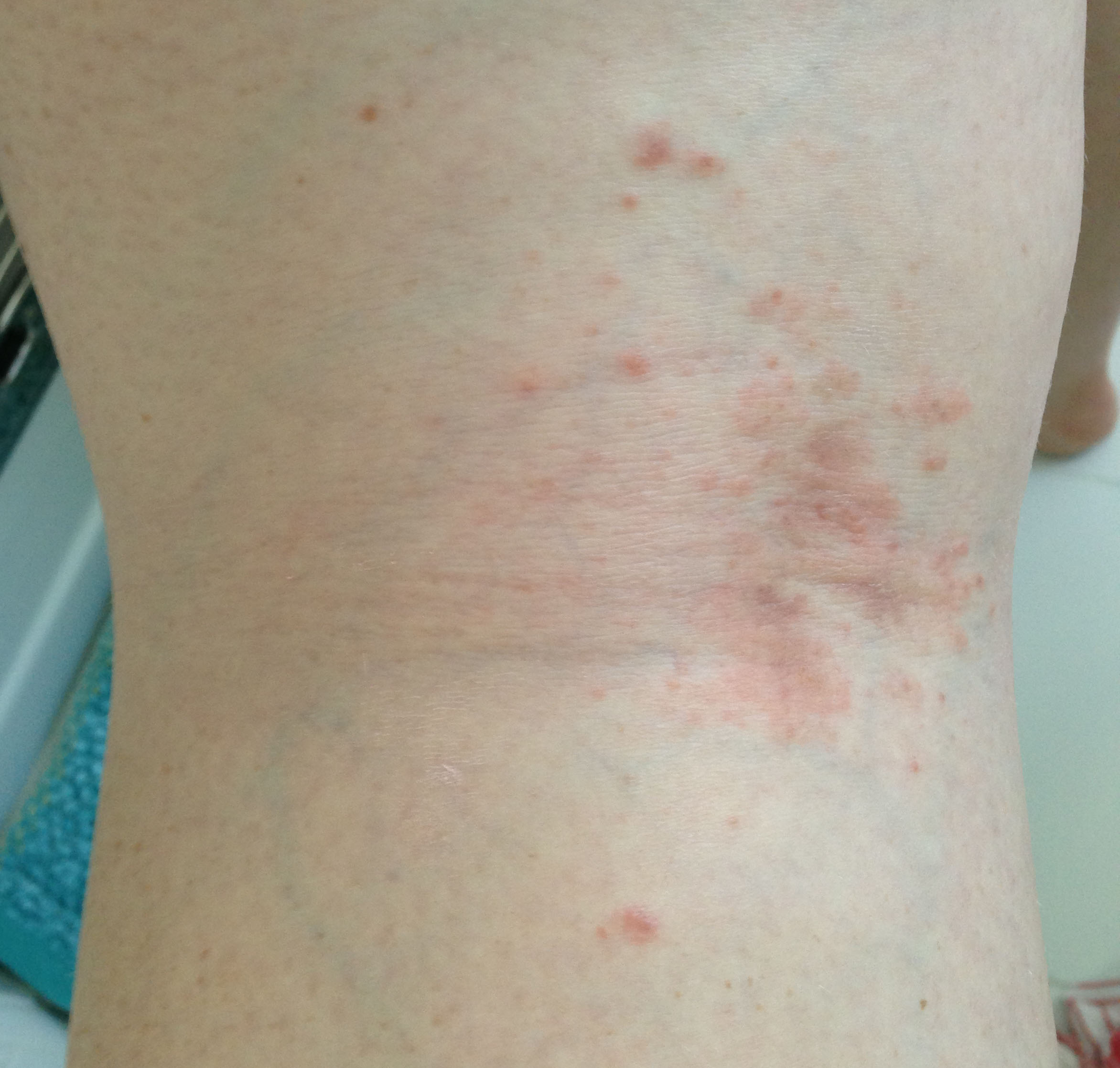 itchy rash buttocks candida infection bumpy groin